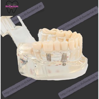 Oral pathology model doctor patient communication model comprehensive pathology model dental implant model