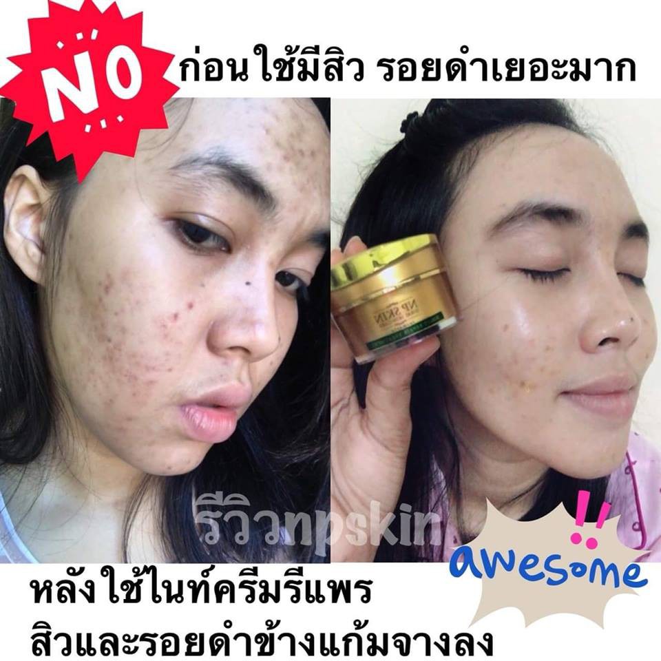 np-skin-ไนท์ครีม-รักษาสิว-ฝ้า-มีบริการ-cod-เก็บเงินปลายทาง-พร้อมส่ง