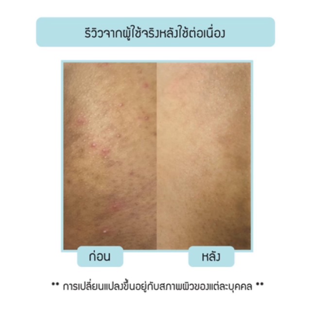 ส่งฟรี-2หลอด-nakiz-lively-butt-ครีมลดบั้นท้ายดำ-ขาหนีบดำ-รักแร้ดำ-หัวเข่าดำ-ข้อศอกดำ-นาคิซ-ครีม-nakiz-ครีมแตกลาย