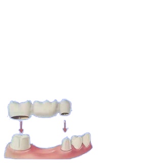 ◊☸℗ทำด้วยตัวเอง กาวพอร์ซเลน กาวติดฟัน วัสดุกาวทันตกรรมพิเศษ กาวสำหรับฟันปลอม