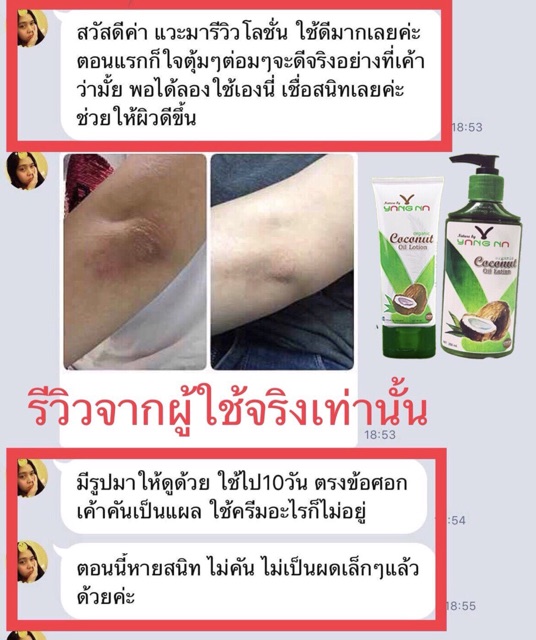 ขายดี-โลชั่นน้ำมันมะพร้าวสกัดเย็น-รักษาน้ำเหลืองไม่ดี-แพ้ยุง-แพ้อากาศ-ออแกนนิค