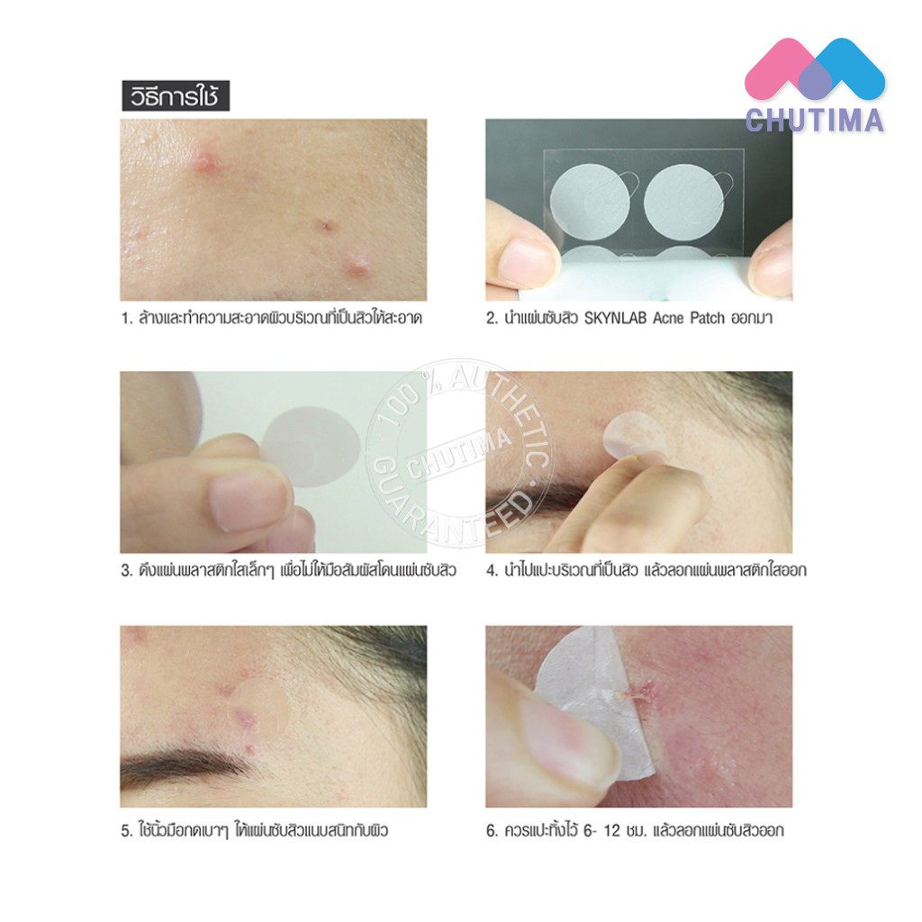 แผ่นแปะสิว-สกินแล๊ป-skynlab-acne-patch-1แผ่น-มี-10-ชิ้น