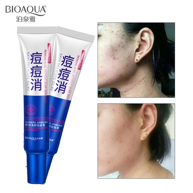 พร้อมส่ง-ครีมรักษาสิว-เจลรักษาสิว-ครีมแต้มสิว-ครีมลบสิว-ครีมรักษารอยสิว-acne-treatment-cream-anti-acne-scar