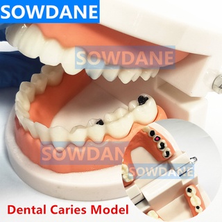 Dental Tooth Model Teeth Model Dental Caries Model for Patient Communication Dentist Study Model with Decayed Tooth