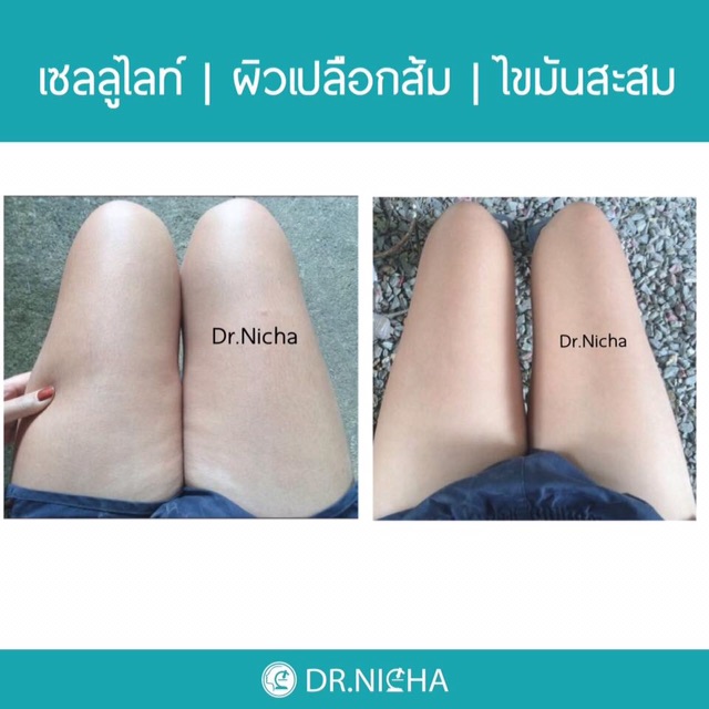 ส่งฟรี-ดร-ณิชา-เจลสลายไขมันสูตรเย็น-1ชิ้น-640