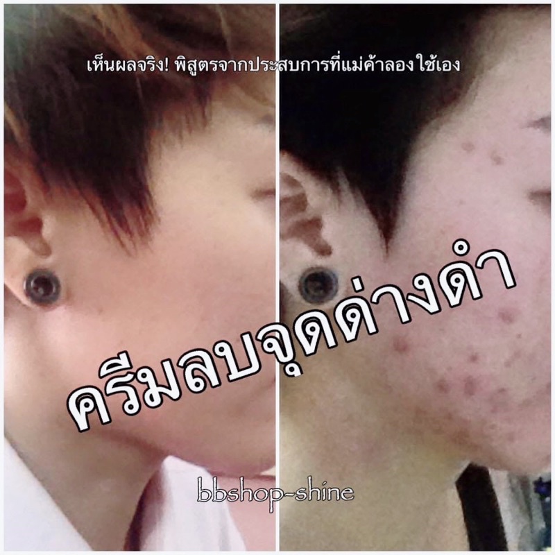 รักษารอยสิว-ครีมลบรอยสิว-แผลเป็น