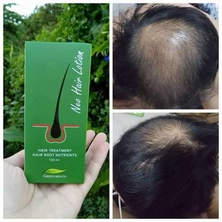 ภาพขนาดย่อของภาพหน้าปกสินค้า(2ขวด)ของแท้ นีโอแฮร์ exp.2024 Neo Hair Lotion ผลิตภัณฑ์ปลูกผม สเปรย์ปลูกผม รับจากบริษัทโดยตรง จากร้าน beauty.matter บน Shopee ภาพที่ 4