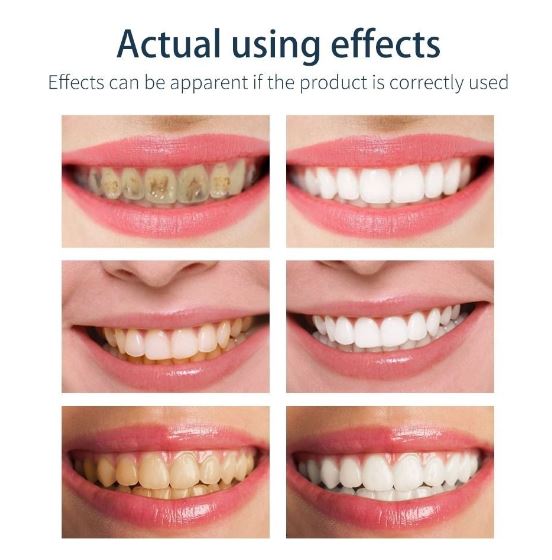 ชุดขูดหินปูน-4-ชิ้น-ที่ขูดหินปูน-ทำความสะอาดช่องปาก-ขูดหินปูน-dental-treatment-kit-ชุดอุปกรณ์ทำความสะอาดฟันขูดหินปูน