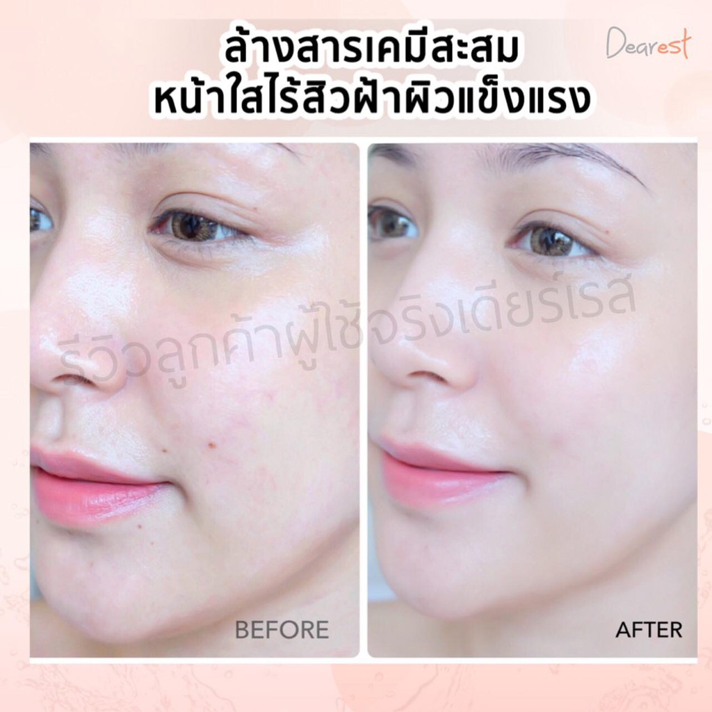 ส่งฟรี-dearest-2in1-mask-amp-clean-เจลล้างหน้าสูตรเซรั่ม-เดียร์เรส-สูตรลดสิว-สลายสิวฝ้ากระเร่งด่วน-100ml