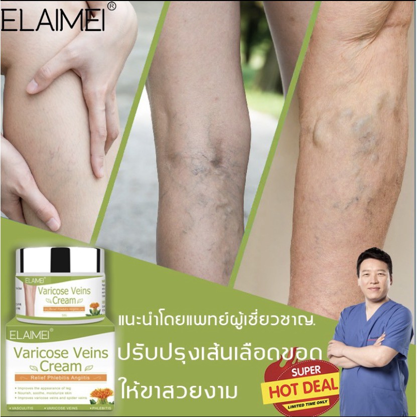 ภาพหน้าปกสินค้าVaricose Veins Cream สำหรับทาเส้นเลือดขอด เป็นยาทาเส้นเลือดขอดที่ช่วยส่งเสริมการไหลเวียนเลือดบรรเทาอาการบวมชา 50 กรัม จากร้าน niwet_store บน Shopee