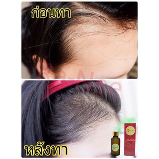 ภาพหน้าปกสินค้าเห็นผลจริง!! เซรั่มปลูกผมRanee Hair Serum แบบลูกปัดและลูกกลิ้ง ขนาด 15 ml. เซรั่มปลูกผม ไรผม คิ้ว เครา หนวด ที่เกี่ยวข้อง