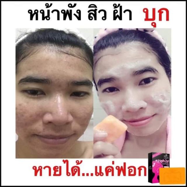 สบู่กูลต้า-ไวท์-รักษาสิว-ฝ้า-100-ก้อน