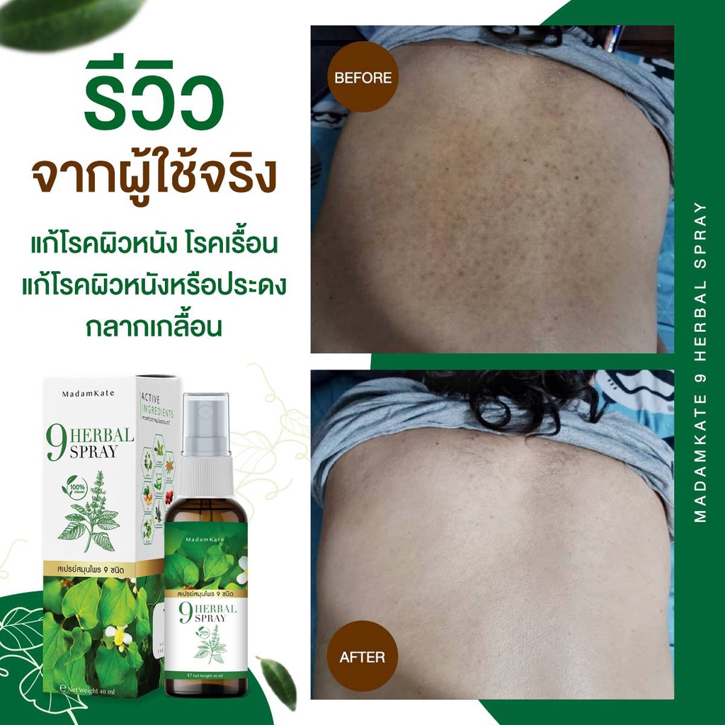 สเปรย์-9-herbal-spray-สมุนไพร9-ชนิดรักษาเชื้อรา-กลากเกลื้อน-ผิวอักเสบ-สะเก็ดเงิน-ผื่นคัน-คันในร่มผ้า-เรื้อนกวาง-เเค่ฉีดก