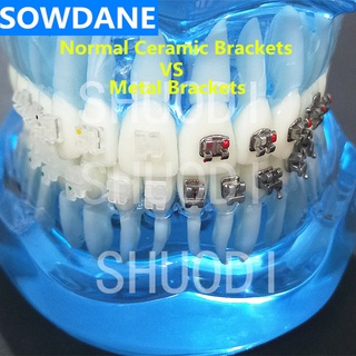 Blue Transparent Dental Orthodontic Model with Ceramic and Metal Brackets for Patient Communication ( Left Right)