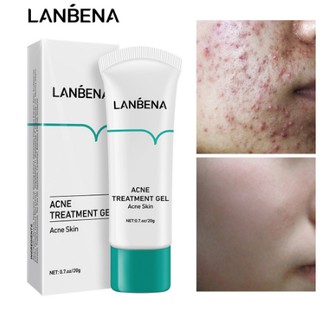 LANBENA gel trị mụn, sữa rửa mặt, kem trị mụn trên da mặt, sẹo do mụn, chăm sóc da, phục hồi Comedone mụn