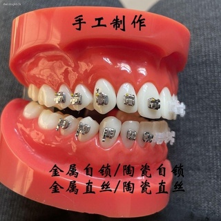 ◊☎☇ทันตกรรมรุ่น Self-locking วงเล็บจัดฟันครึ่งปาก Cermet วงเล็บเปรียบเทียบรุ่นจัดฟัน Show