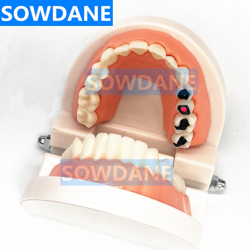 dental-tooth-model-teeth-model-dental-caries-model-for-patient-communication-dentist-study-model-with-decayed-tooth