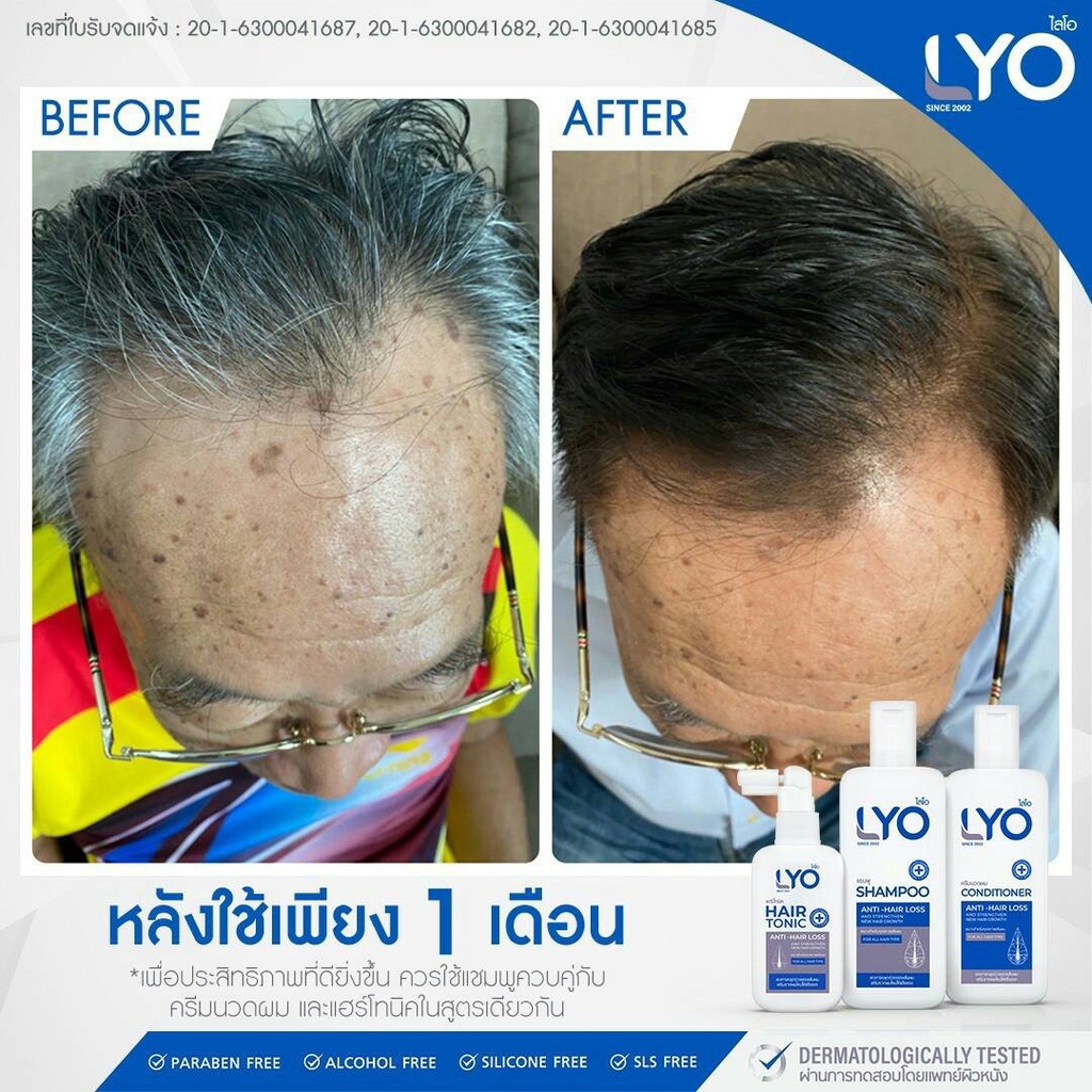 โปรสุดคุ้ม-lyo-ไลโอ-ผลิตภัณฑ์ดูแลเส้นผม-hair-tonic-บำรุงเส้นผม-ลดผมบาง-ผมร่วง-รังแค