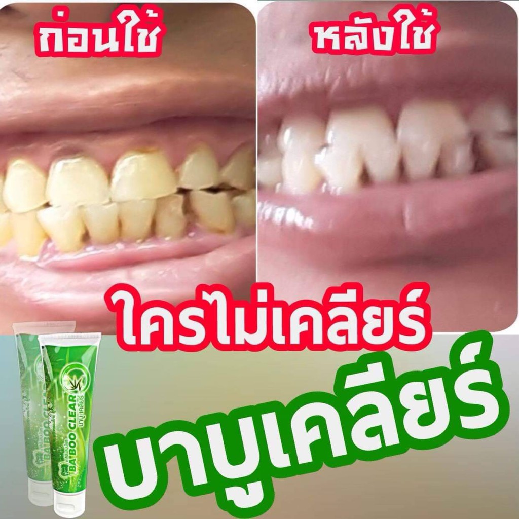 หินปูน-กลิ่นปาก-เหงืออักเสบ-ฟัน-เหลือง-ตื่นเช้ามาจากกลิ่นปากแรงๆ-babooclear-เคลียร์ให้