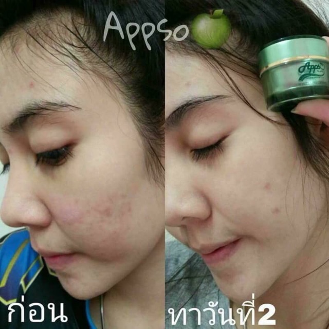 แอปโซ-หน้าขาวกระจ่างใส-ลดสิว