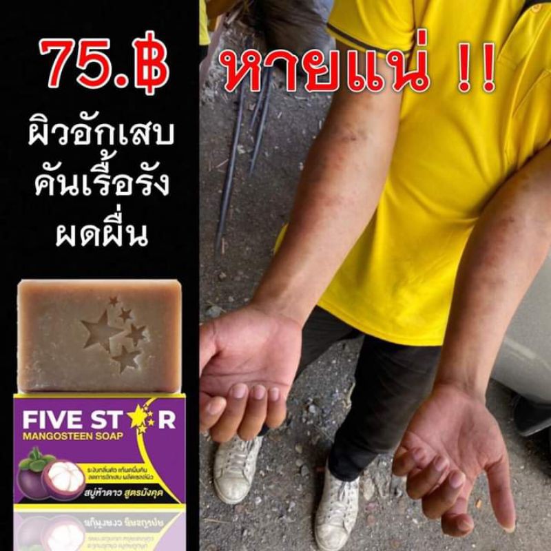 สบู่มังคุด5ดาว-5-ก้อน-ส่งฟรี-รักษาโรคผิวหนังทุกชนิด