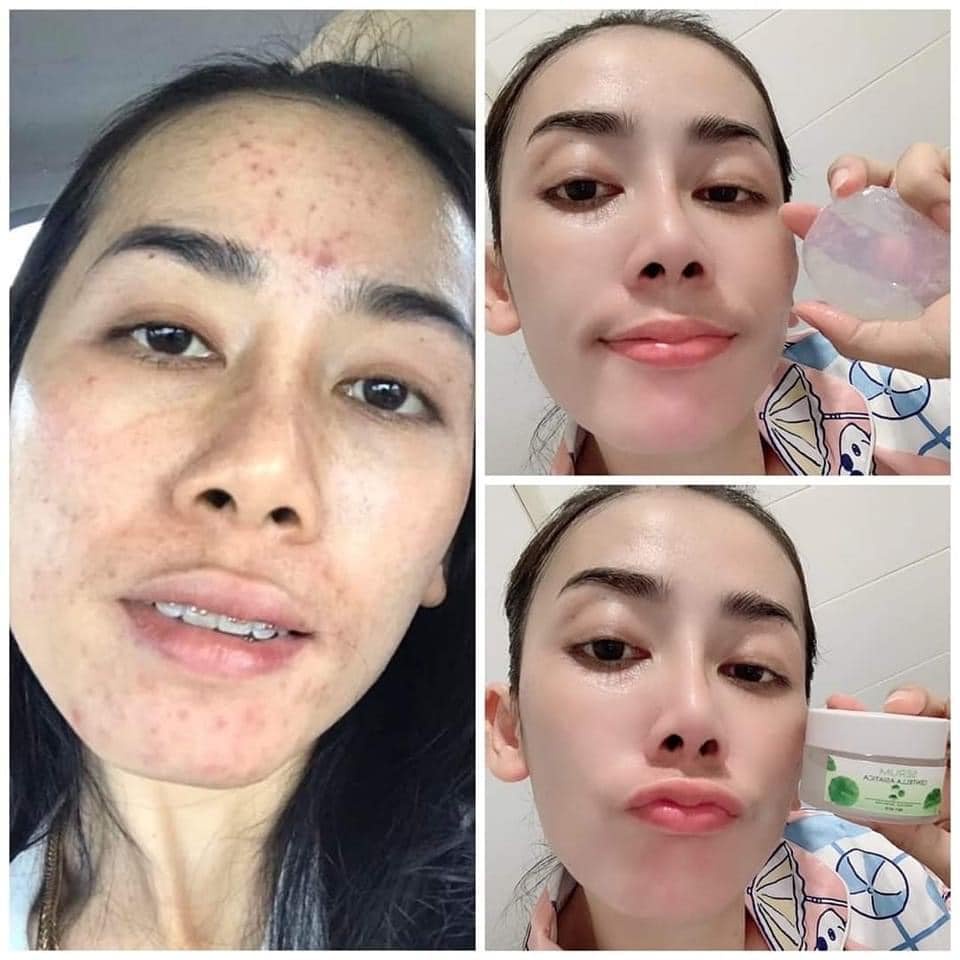 ส่งฟรี-เซรั่มใบบัวบก-เซรั่มลดสิว-เซรั่มหน้าใส-พรทิน่า-ผสมว่านหางจรเข้-ฟื้นฟู-บำรุงผิว-ลดสิว-ลดการอักเสบ-ผดผื่น-หน้าใส