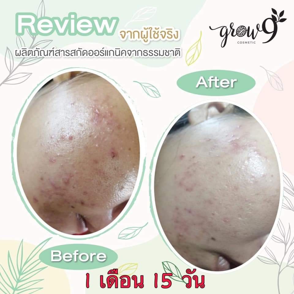 grow9-bigset-10-ชิ้น-ครีมออแกนิค-คนท้องใช้ได้-เด็กใช้ได้-ลดสิวฝ้ากระ-ผิวเด้งดุจผิวเด็ก