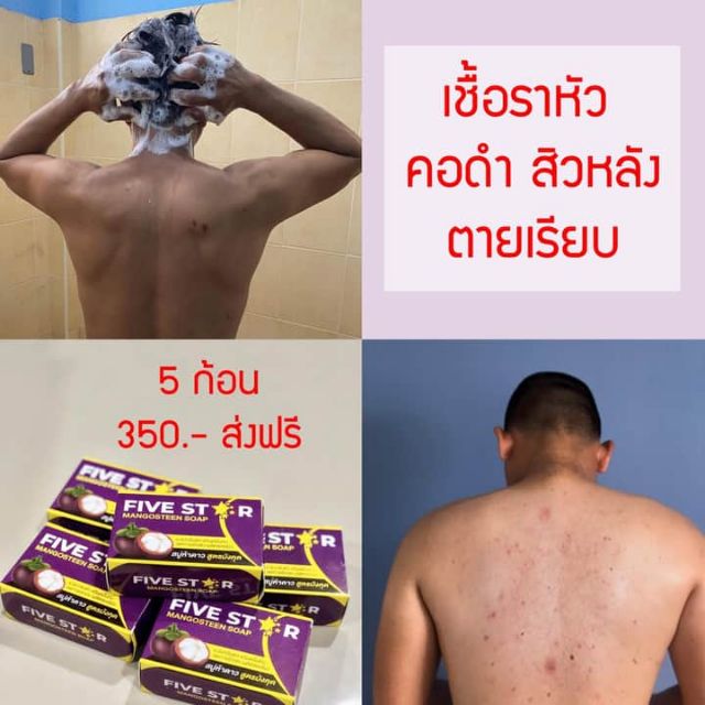 สบู่มังคุด5ดาว-ของแท้-five-star-รักษาโรคผิวหนังทุกชนิด-ฟรีตาข่ายตีฟอง