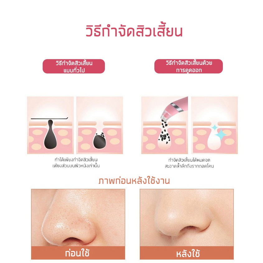 vanrro-เครื่องทำความสะอาดสิวเสี้ยนและกระชับรูขุมขน-ดูดสิวเสี้ยน-สิวอุดตัน-สิวหัวดำ-สิวหัวขาว