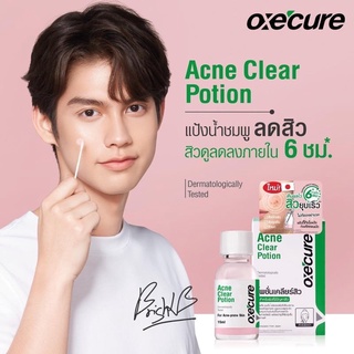 แท้💯% Oxecure แต้มสิว แป้งน้ำชมพูลดสิว Acne Clear Potion 15 ml จากประเทศญี่ปุ่น OX0002 เจลแต้มสิว ลดสิว รอยดำ