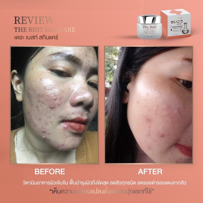 ครีม-เซรั่มเดอะเบสท์-the-best-skincare-ครีมบำรุงผิวหน้า-รักษาสิว-ของแท้