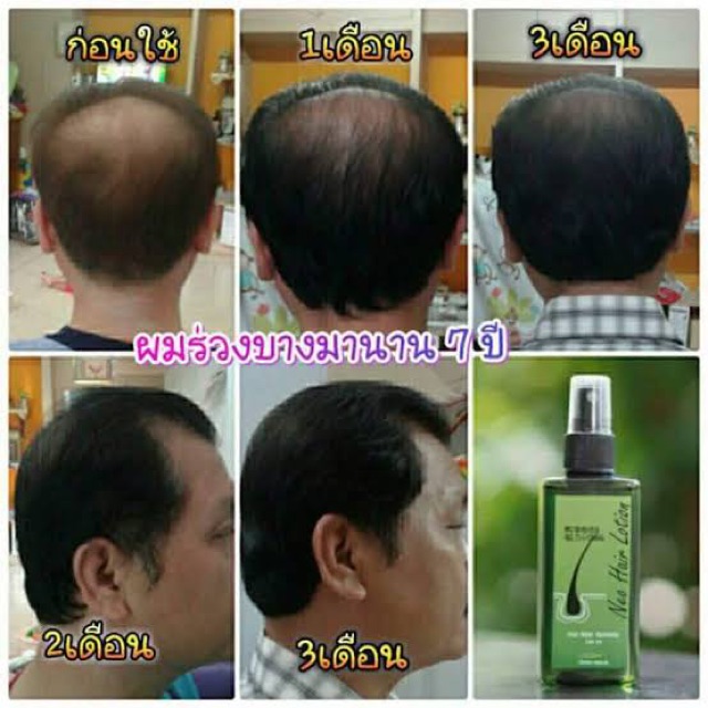 นีโอแฮร์โลชั่น-neohair-ของแท้100-ของใหม่ล่าสุด