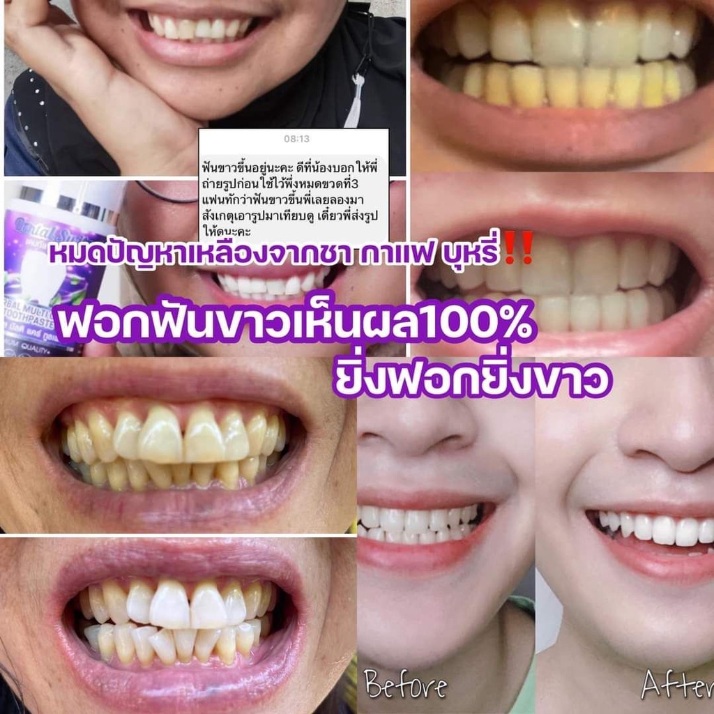 1แถม1-รางฟอก-ส่งฟรี-ไม่ต้องใช้โค้ด-เจลฟอกฟันขาว-ยาสีฟันฟอกฟันขาว-dental-switz-ฟันขาวฟอกเองที่บ้าน