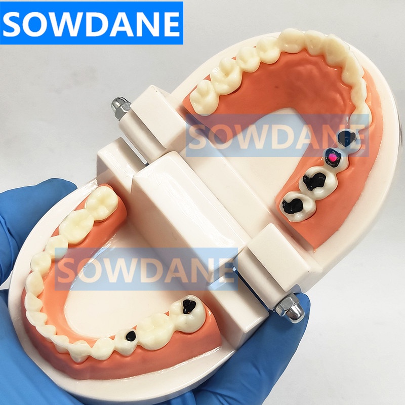 dental-tooth-model-teeth-model-dental-caries-model-for-patient-communication-dentist-study-model-with-decayed-tooth