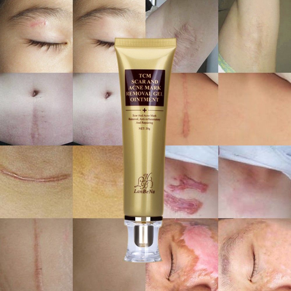 lanbena-acne-scar-removal-cream-skin-repairครีมกำจัดรอยแผลเป็นจากสิว-ครีมซ่อมแซมผิวหน้าให้ความชุ่มชื้นไวท์เทนนิ่งครีม