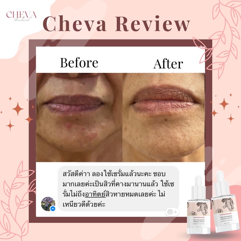 cheva-booster-serum-แบบแพ็คคู่สุดคุ้ม-เซรั่มหน้าใส-ป้องกันการเกิดสิว-ลดรอยสิว-กู้ผิวเด็ก-ด้วยสารสกัดจากธรรมชาติ-100