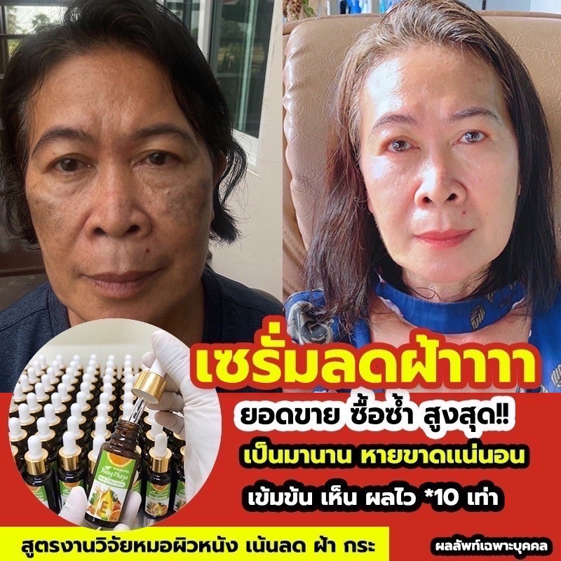 ส่งฟรี-เซรั่มนางพญา-เซรั่มลดฝ้า-ตัวดังในติ๊กต็อก-ลดฝ้าแดด-ฝ้าหนา-ฝ้าลึก-กระลึก-สลายฝ้า-ลดเลือนริ้วรอย