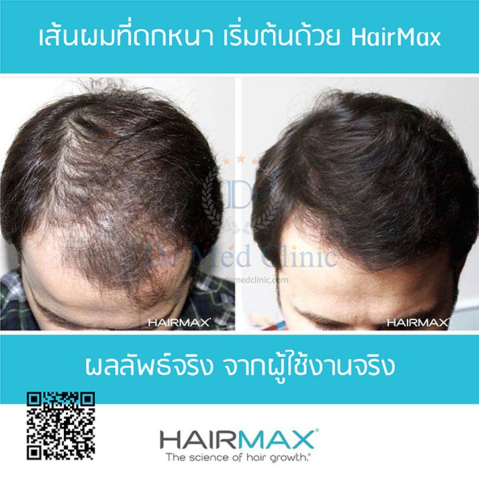 hairmax-regrow-md-laser-272-หมวกเลเซอร์-ราคาปกติ79-900บาทพิเศษ69-900-บาท-แถมพิเศษ-triple-h-treatment-1-ครั้ง-demed