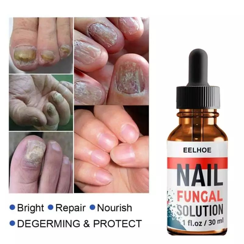 nall-fungal-วิธีแก้ปัญหาการรักษาเชื้อราเล็บ-มือและเล็บเท้าที่แข็งแรงติดเชื้อรา