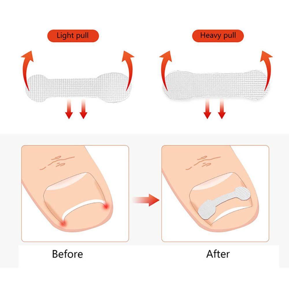 alisond1-สติกเกอร์ติดเล็บขบ-10-ชิ้น-ชุด-เครื่องมือทําเล็บเท้า-รักษาโรคมะเร็ง-แผ่นแปะเล็บเท้า-ดูแลเท้า-แผ่นแปะสติกเกอร์แก้ไข