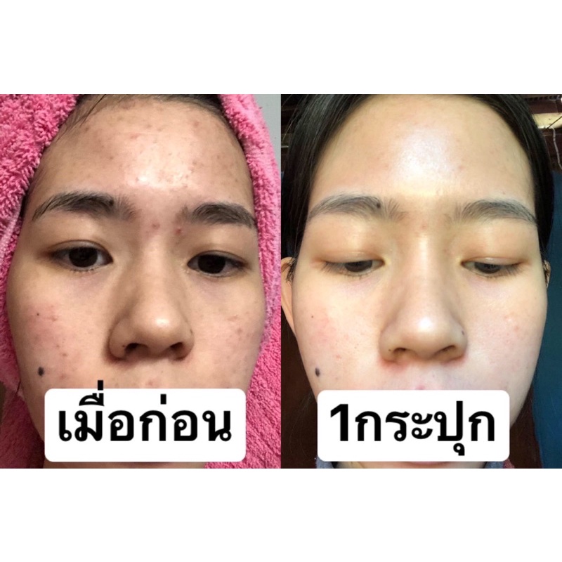 โสมเฌอริตา-ของแท้100-ลดสิว-ลดรอย-หน้าขาวใส-เห็นผลตั้งแต่กระปุกแรก