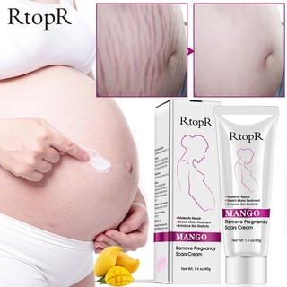 ครีมทาท้องลาย แก้ท้องลาย ลดรอยแตกลาย ขาแตกลาย สะโพกลาย​ ผิวลาย รอยแตก​ลาย RtopR MANGO REMOVE PREGNANCY SCARS CREAM 40 g.