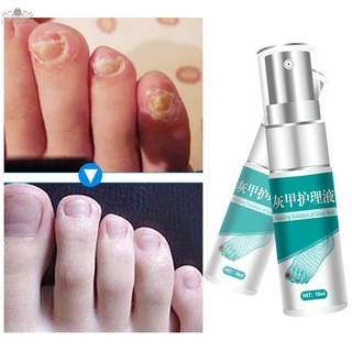 ภาพหน้าปกสินค้า【DREAMER】Nail Fungal Treatment Essence Nail Foot Whitening Toe Nail Fungus Removal Gel Anti Infection Paronychia 10ml ที่เกี่ยวข้อง