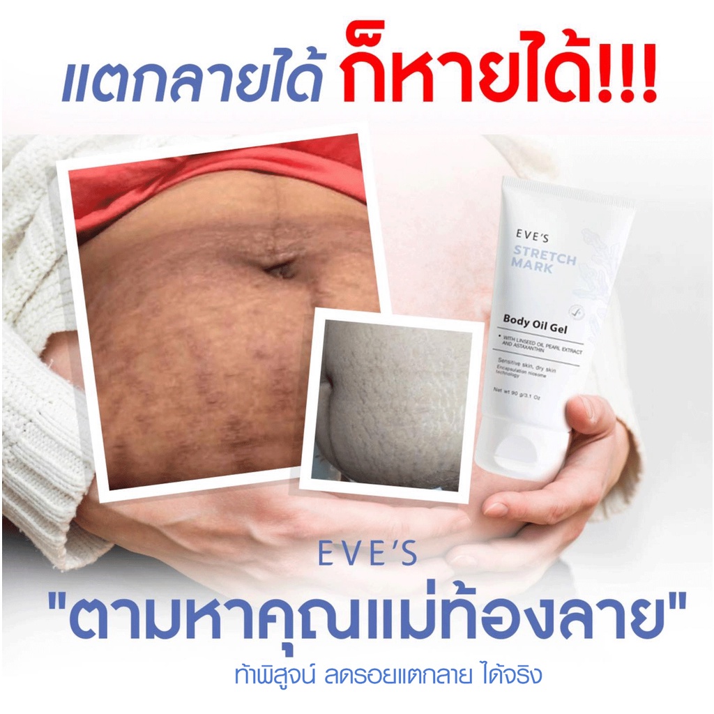 eves-บอดี้ออยล์เจลอีฟส์-stretch-mark-body-oil-gel-ผิวนุ่มชุ่มชื้น-ลดรอยแตกลาย-ป้องกันแตกลาย-ลดรอยแผลเป็นจุดด่างดำ