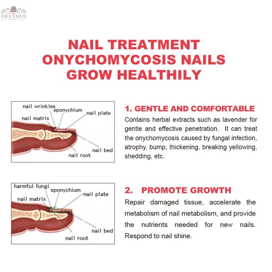 dreamer-เอสเซ้นบํารุงเล็บเท้า-ป้องกันเชื้อราที่เล็บ-โรคเชื้อราที่เล็บ-เล็บเท้า-เล็บเท้า-เล็บเท้า