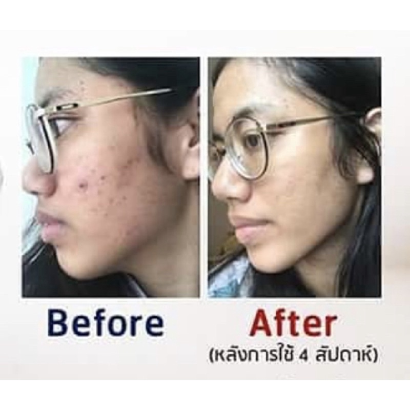 ดีที่สุด-ครีมลดสิว-pana-perfect-anti-acne-cream