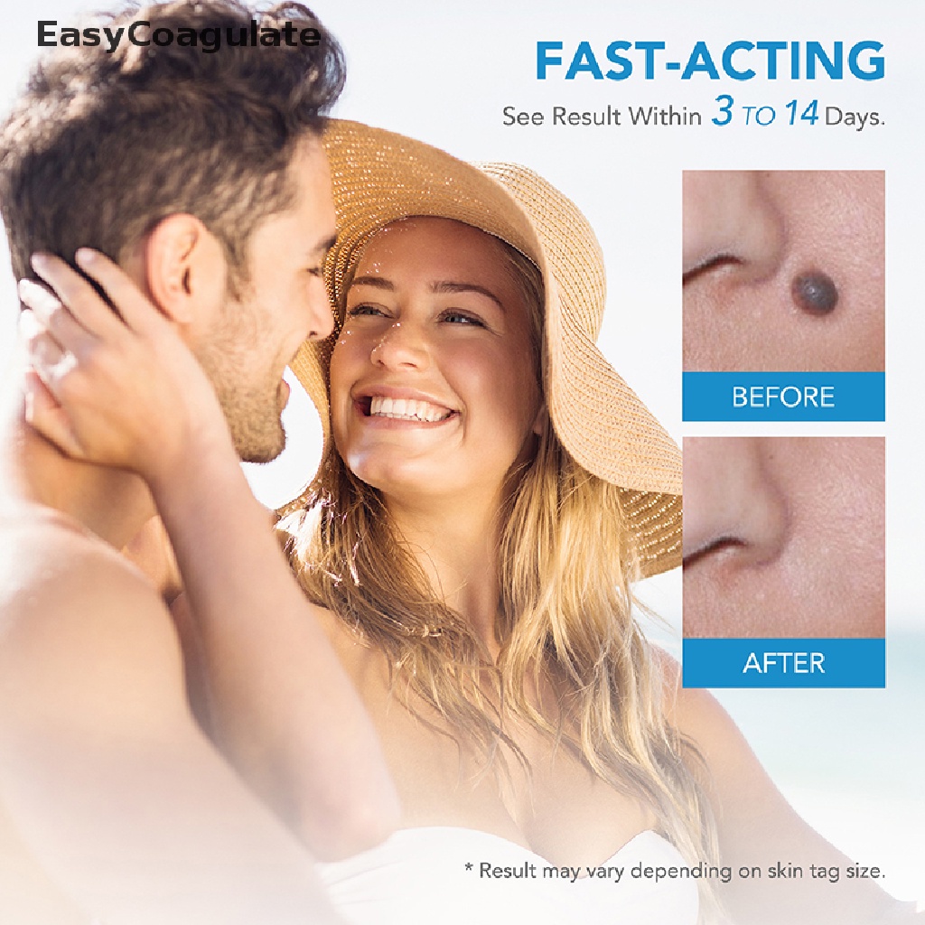 eas-painless-auto-skin-tag-removal-kit-skin-tag-bands-remover-device-new-ate