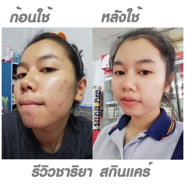 9-9-แถมสบู่-เซ็ทขายดี-ชุด-960-ปราบสิว-ปราบรอยสิว-ของแถมมีจำนวนจำกัด