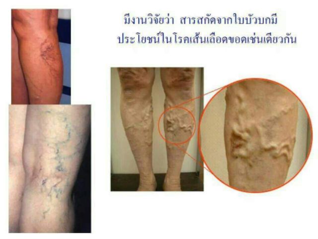 กิฟฟารีน-โกตูล่า-ซีอี-ใบบัวบกสกัด-แก้ริดสีดวง-เส้นเลือดขอด-ลดเบาหวาน-รักษาแผลเบาหวาน-gotura-c-e-giffarine