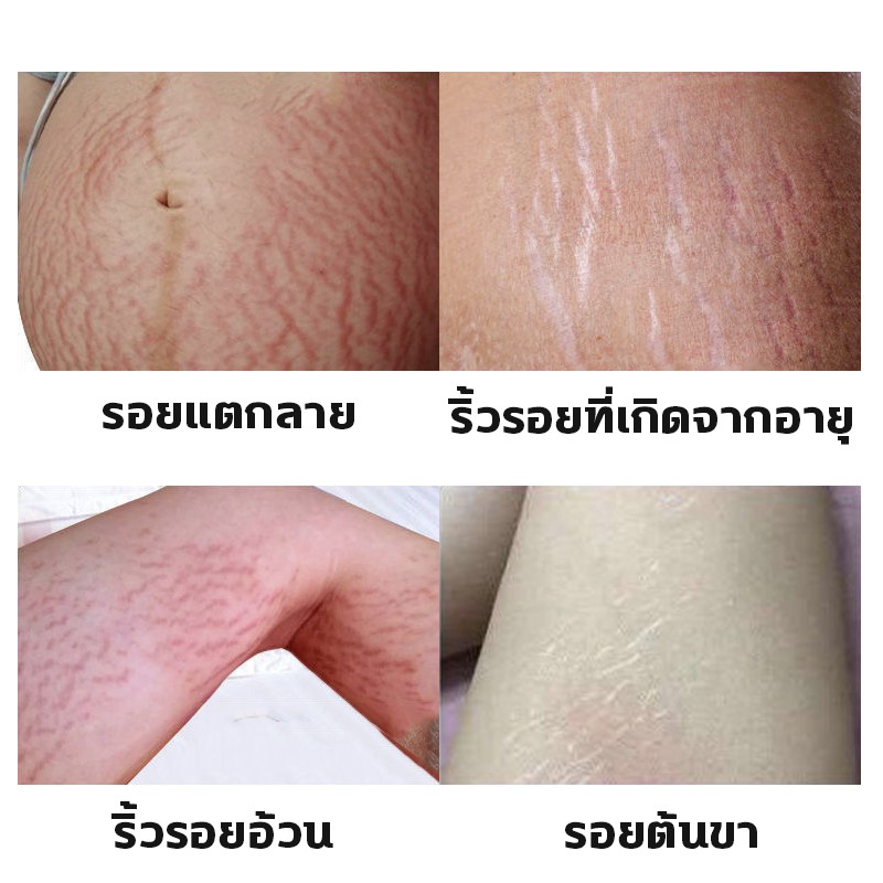 guanjing80g-ยาทารอยแตกลาย-ครีมทาลดรอยแตก-ครีมลดรอยแตกลาย-ครีมแก้แตกลาย-ครีมแก้ท้องลาย-ครีมทาแตกลาย-ครีมกันแตกลาย